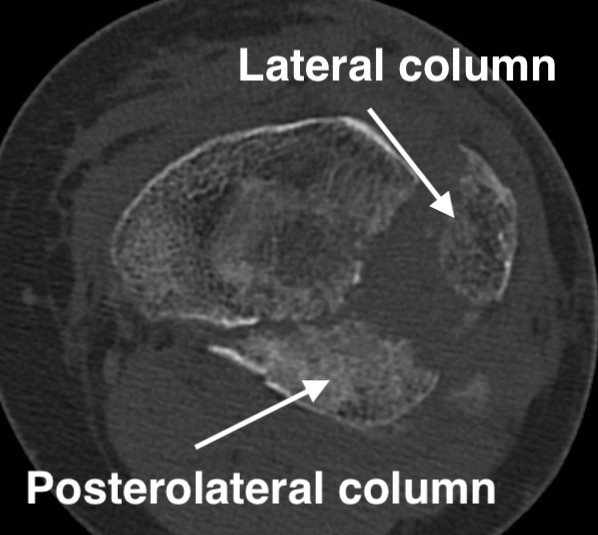 3 column tibial plateau classification